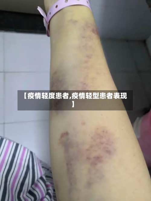 【疫情轻度患者,疫情轻型患者表现】-第1张图片